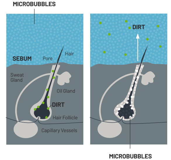 micro bubbles diagram diagram shows that micro bubble technology works to push dirt out from hair follicles